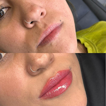 Preenchimento labial